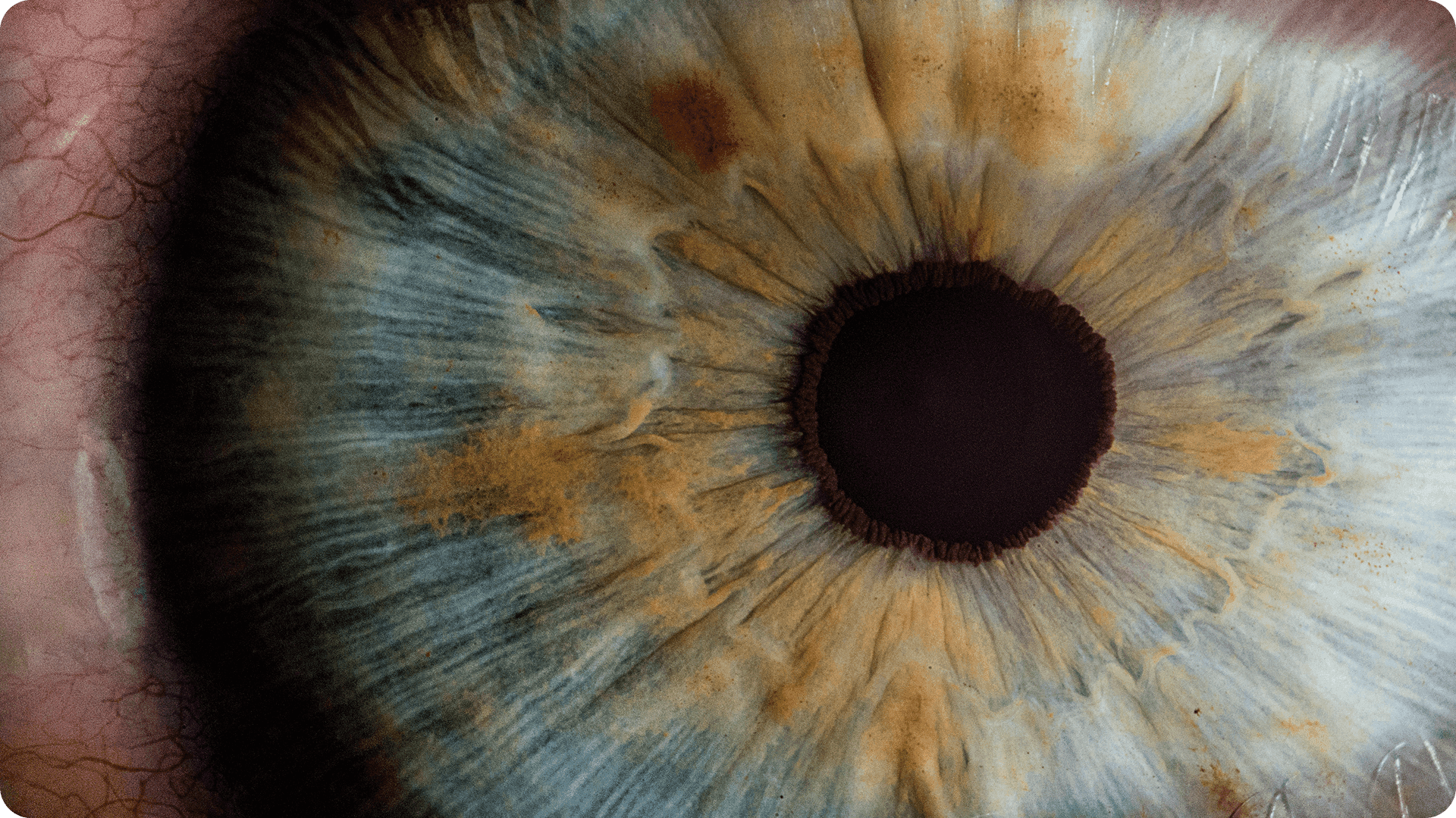 Catarata: como softwares aumentam a adesão às cirurgias